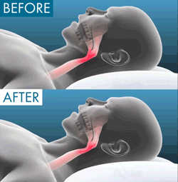 Plus Anti-Snore Mouthpiece - Image 8