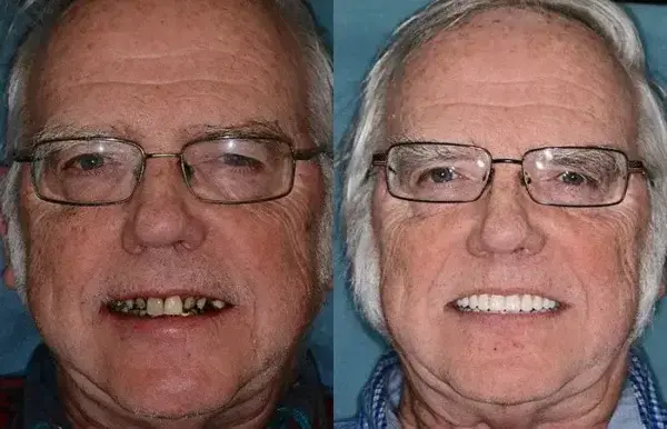SMILE Premium Denture - Image 8