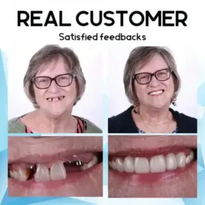 Premium Custom Silicone Denture Set - Image 11