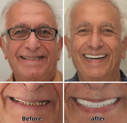 Advanced Custom-Fit Functional Dentures - Image 7