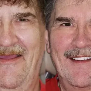 Premium Dentures - Image 5