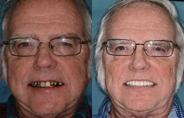 Premium Dentures - Image 6