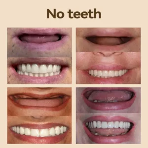 🐱🐉💦- 𝐏𝐫𝐞𝐦𝐢𝐮𝐦 𝐃𝐞𝐧𝐭𝐮𝐫𝐞- (✨Suitable for all mouth shapes, custom-made dentures for a perfect fit✨) - Image 7