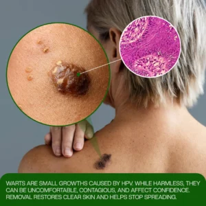Wart Remover Patch - Image 5