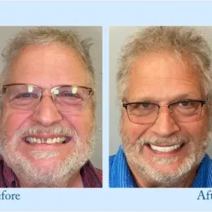 Full Dentures - Image 7