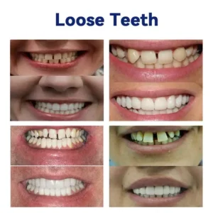 🦷Premium Advanced Customized Full Denture Set 💎 - Image 4