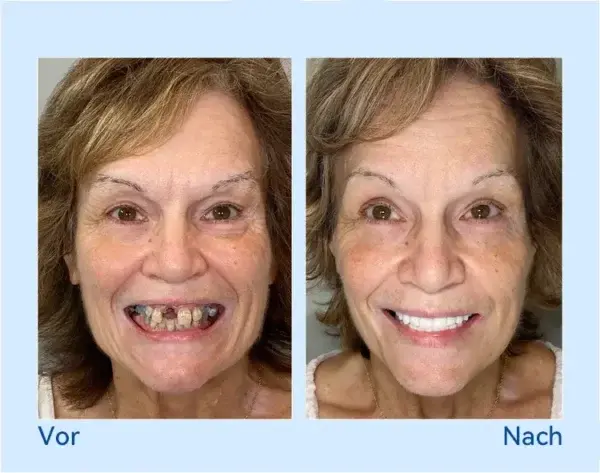 🦷𝐅𝐨𝐫𝐭𝐬𝐜𝐡𝐫𝐢𝐭𝐭𝐥𝐢𝐜𝐡 𝐌𝐚ß𝐠𝐞𝐟𝐞𝐫𝐭𝐢𝐠𝐭 𝐕𝐨𝐥𝐥𝐩𝐫𝐨𝐭𝐡𝐞𝐬𝐞𝐧-𝐒𝐞𝐭 - Image 10