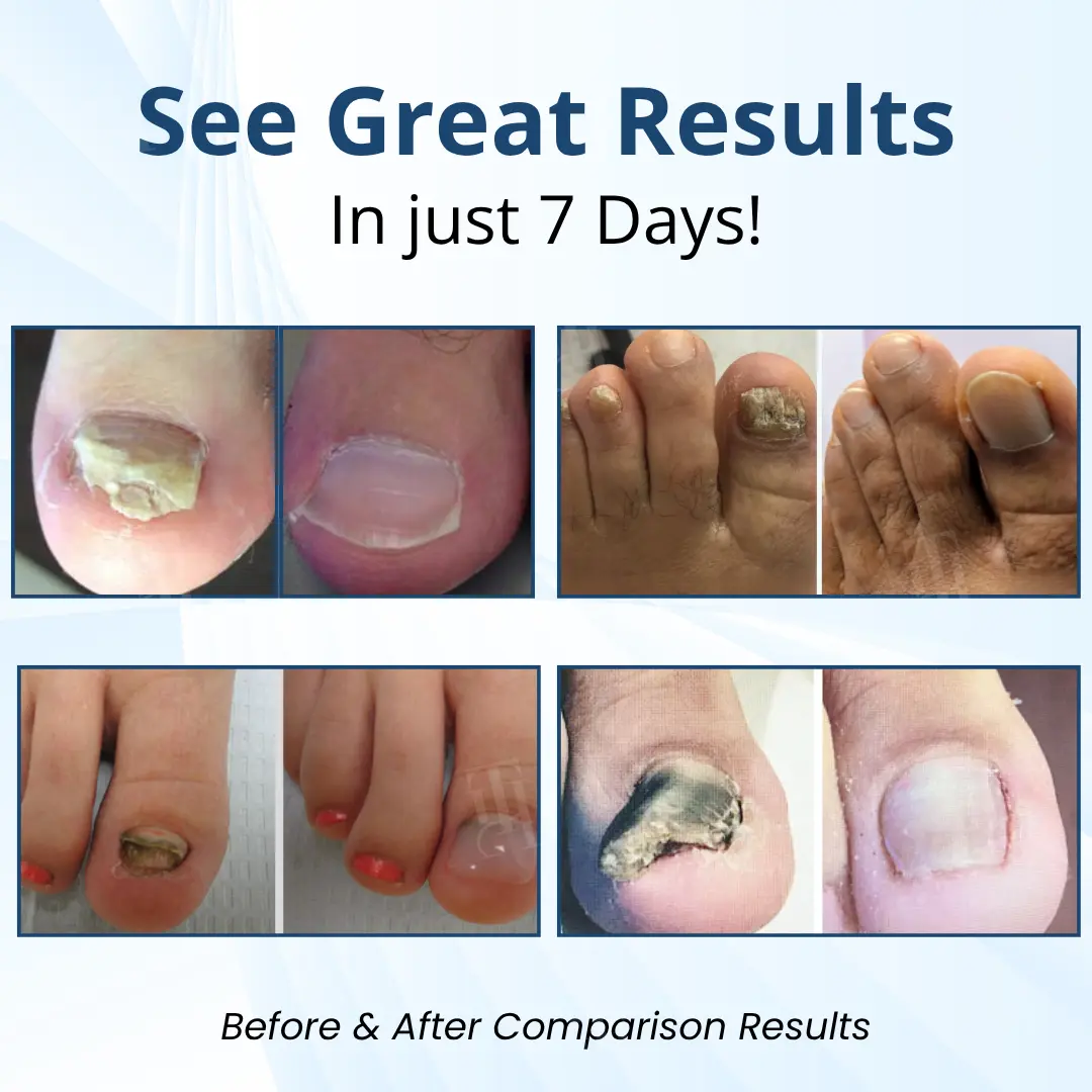 Fungal Nail Patches - Image 4