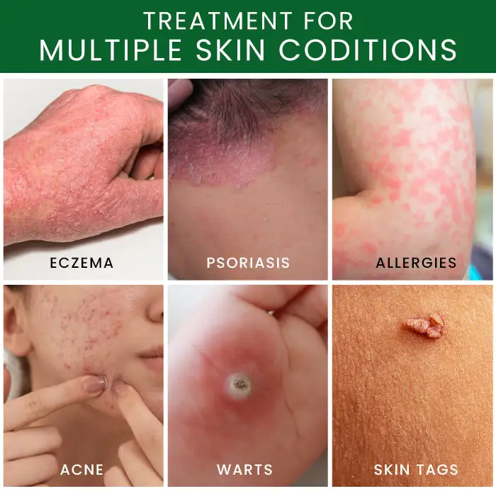 Tea Tree Oil Skin Treatment Cream - Image 6