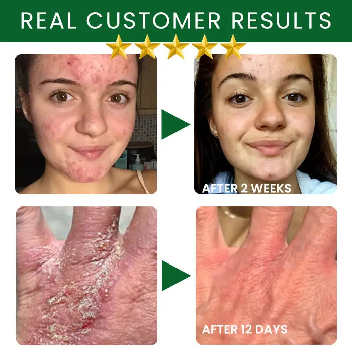 Tea Tree Oil Skin Treatment Cream - Image 8