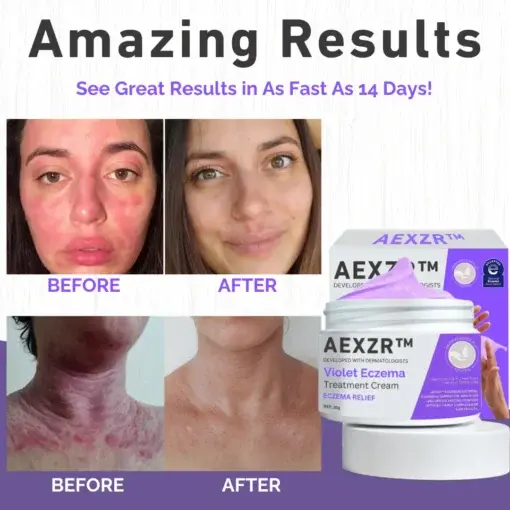 Violet Eczema Treatment Cream - Image 5