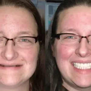 Custom-Fit Functional Dentures - Image 3
