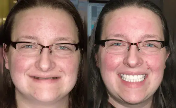 Custom-Fit Functional Dentures - Image 3