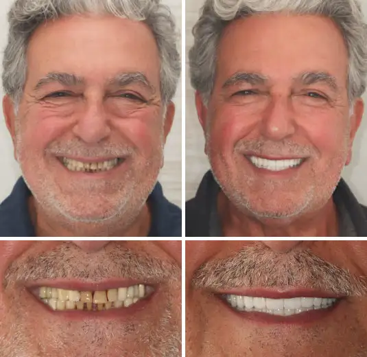 Custom-Fit Functional Dentures - Image 4