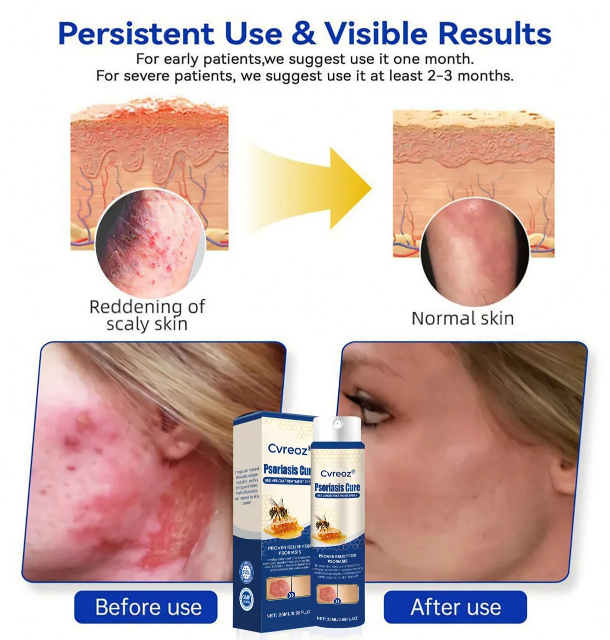 Psoriasis Cure Bee Venom Treatment Spray - Image 4