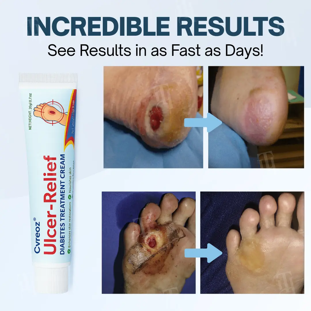 Ulcer-Relief Diabetes Treatment Cream - Image 3