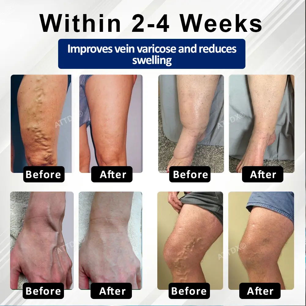 Microneedle Leg Patch - Image 8