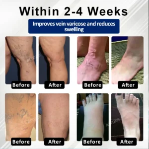 Microneedle Leg Patch - Image 9