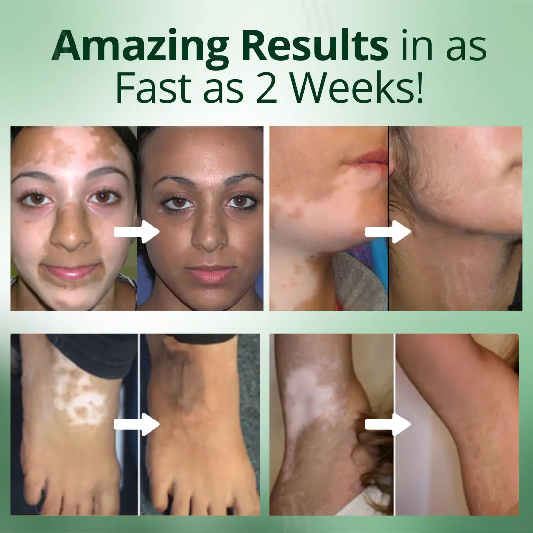 Vitiligo Treatment Cream - Image 6