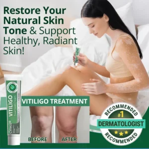 Vitiligo Treatment Cream - Image 5