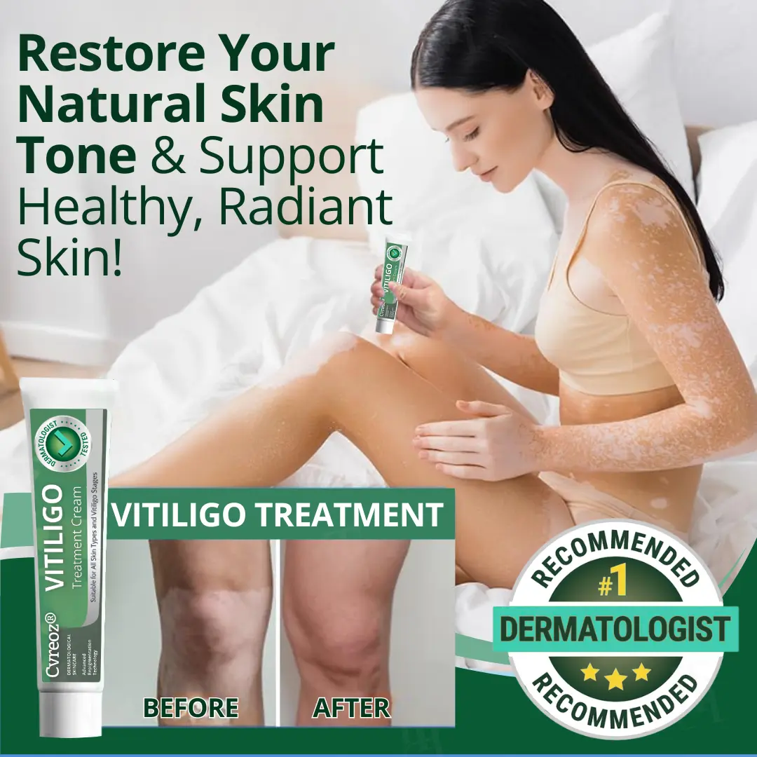 Vitiligo Treatment Cream - Image 5