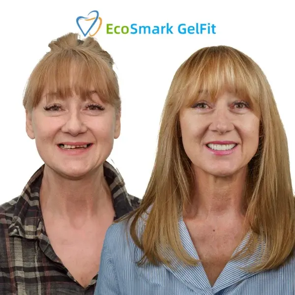 GelFit Dentures - Image 6
