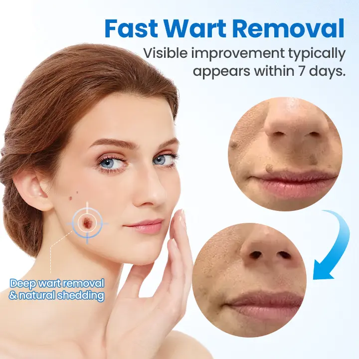Wart Removal Cream - Image 5