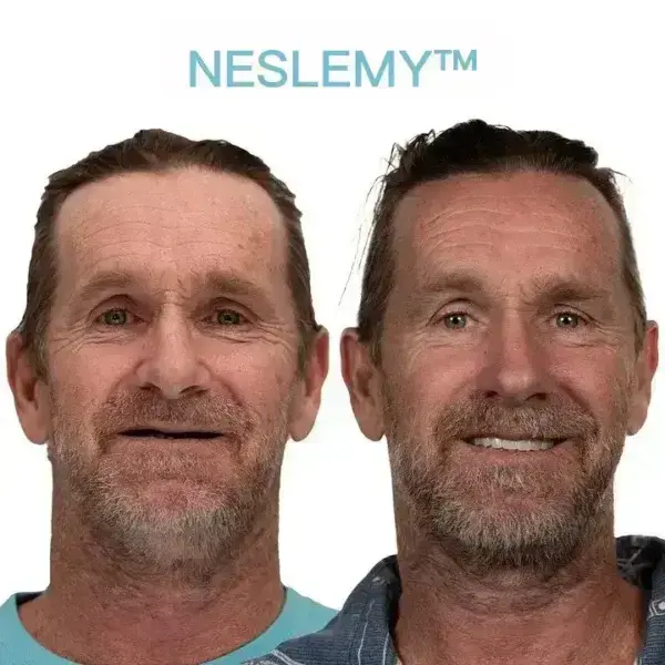 GelFit Dentures - Image 3