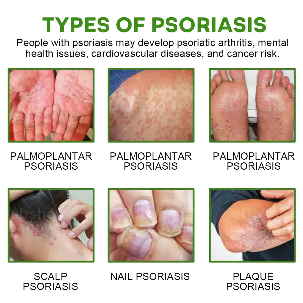 Herbal Psoriasis Relief Cream - Image 5