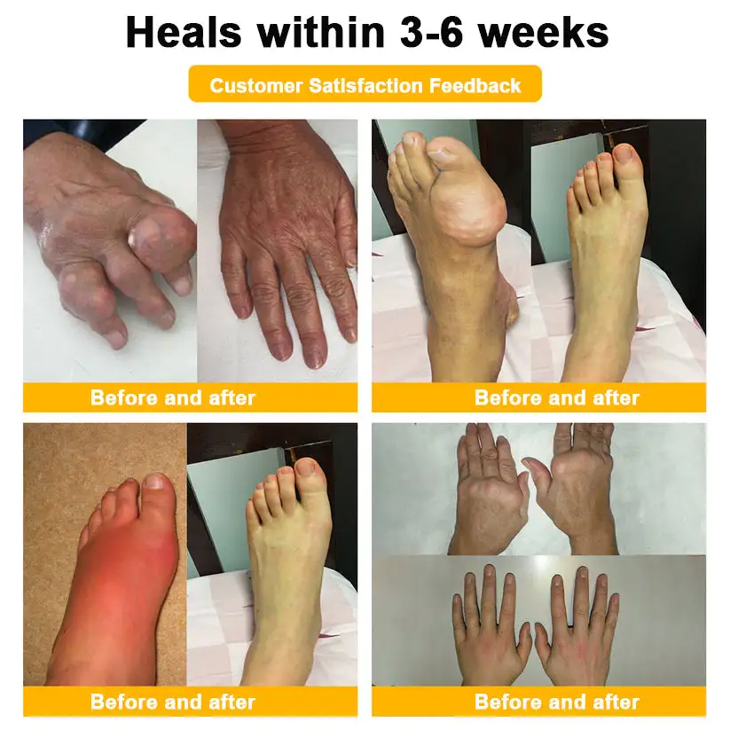 Botulinum Toxin & Bee Venom Pain-Relief Bone Healing Cream - Image 3