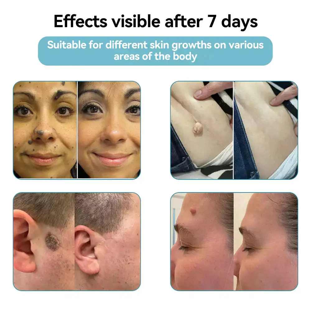 VelvetSkin+ All-in-One Laser Eraser Pen - Image 3