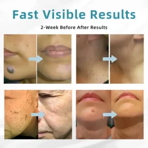 VelvetSkin+ All-in-One Laser Eraser Pen - Image 5