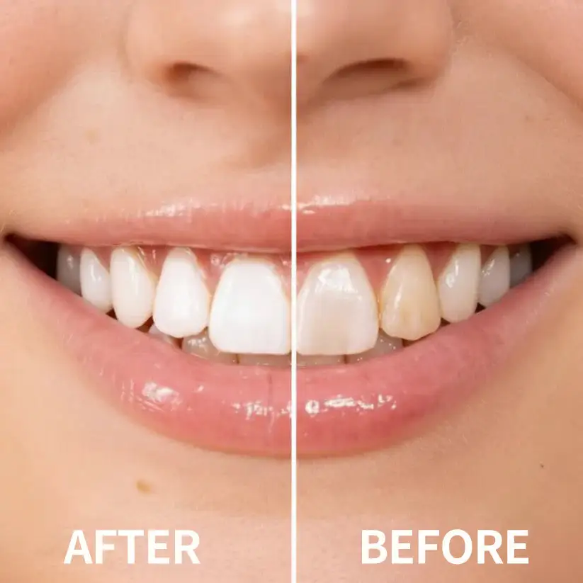 Instantly Whiter Smile🦷 - Image 5