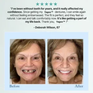 Alternative view of 🦷Advanced Customized Full Denture Set🦷 (🔥10,000+ Sold In Last 30 Day)