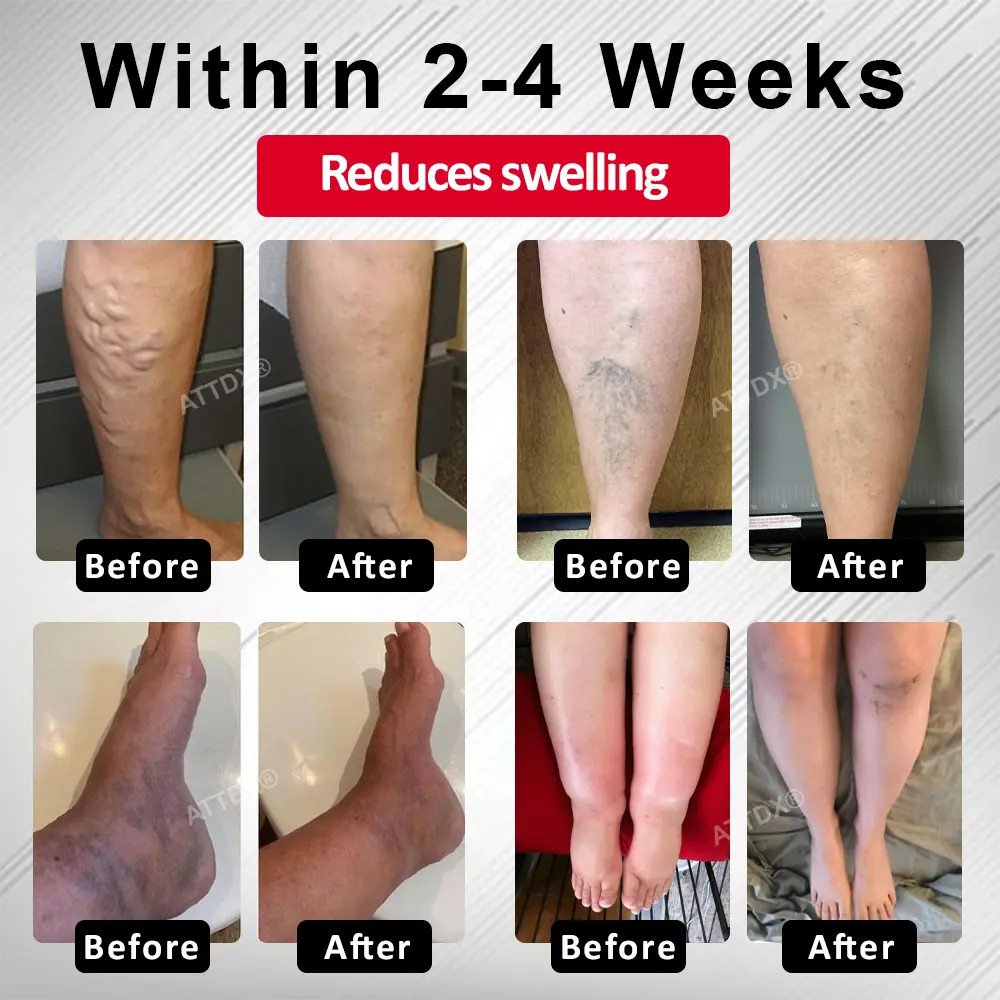 Advanced CVI Edema Therapy Cream - Image 4