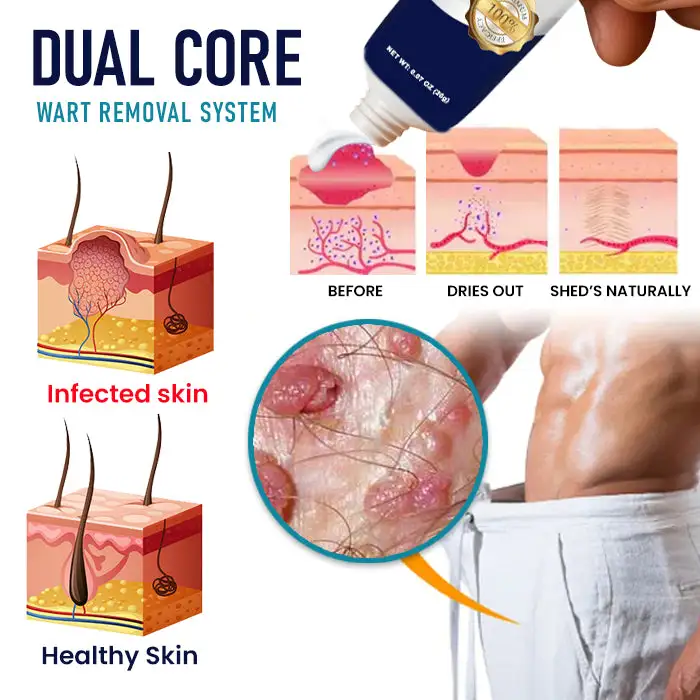 Genital Warts Remover Cream - Image 5