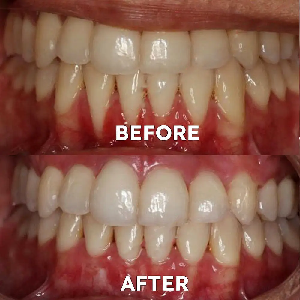 Fluoride-Free Nano Hydroxyapatite Tooth Powder - Image 4