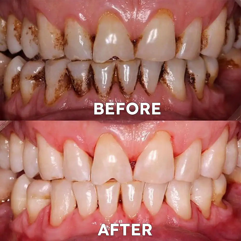 Fluoride-Free Nano Hydroxyapatite Tooth Powder - Image 6