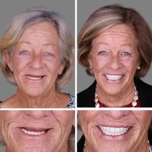 Full Denture with Strong Suctiond - Image 12