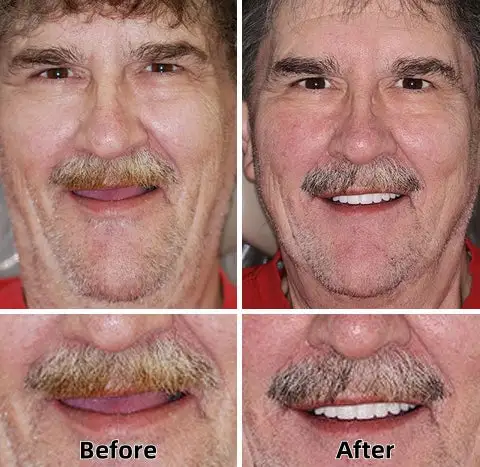 -Advanced Custom-Fit Functional Dentures - Image 8