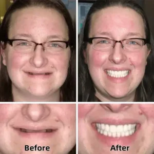 -Advanced Custom-Fit Functional Dentures - Image 7
