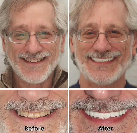 -Advanced Custom-Fit Functional Dentures - Image 6