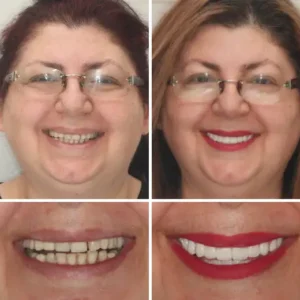 🌟 – Custom-Crafted Dentures That Feel as Natural as They Look👩‍🔬 - Image 10