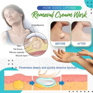 Lipoma Removal Cream - Image 7