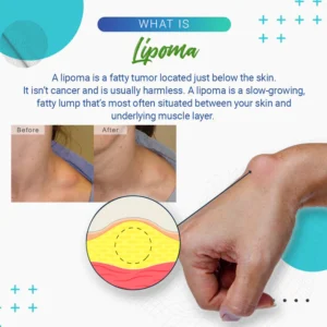 Lipoma Removal Cream - Image 11