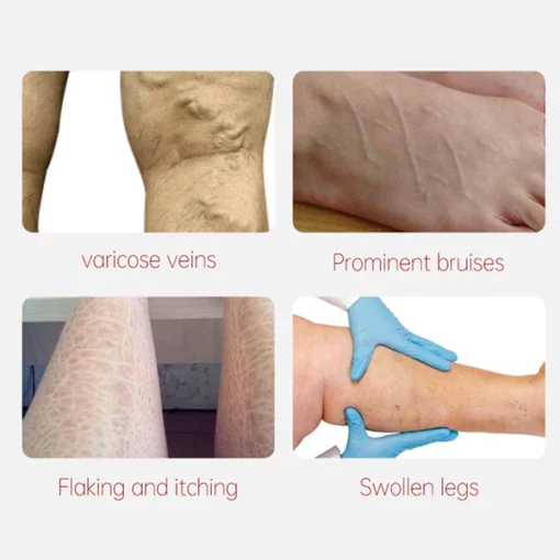 Varicose Veins Relief Cream - Image 6