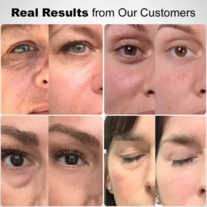 ✅Official Store: Deep Precision Age-Defying Nano Microneedle Patches – Deep-acting solution for tackling under-eye bags, dark circles, laughter lines, forehead lines, and all those other pesky facial wrinkles. - Image 6