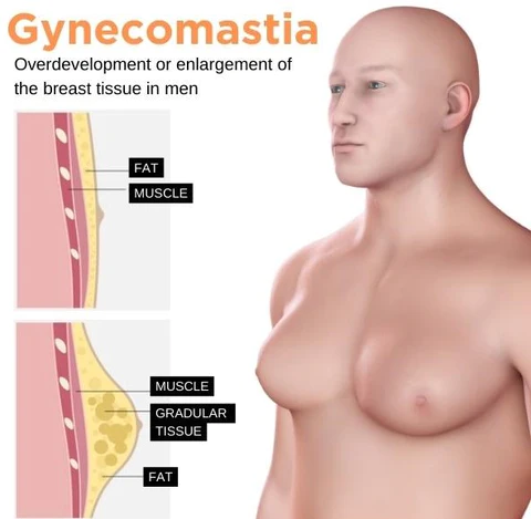 Gynecomastia Cream - Image 6