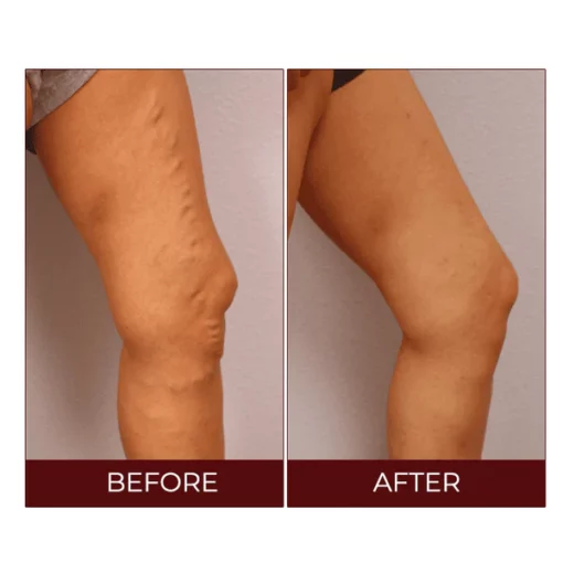 Varicose Veins Relief Cream - Image 5