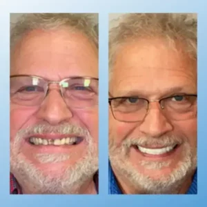 𝗙𝘂𝗻𝗰𝘁𝗶𝗼𝗻𝗮𝗹 𝗧𝗵𝗶𝗰𝗸𝗲𝗻𝗲𝗱 𝗗𝗲𝗻𝘁𝘂𝗿𝗲𝘀 - Image 12